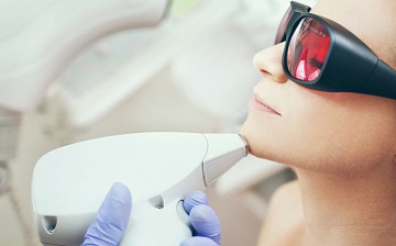 Laser Hair Removal