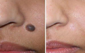 Laser Mole Removal