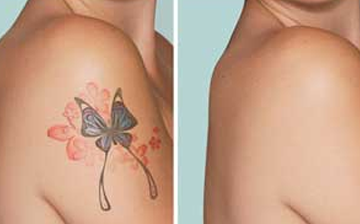 Laser Tattoo Removal