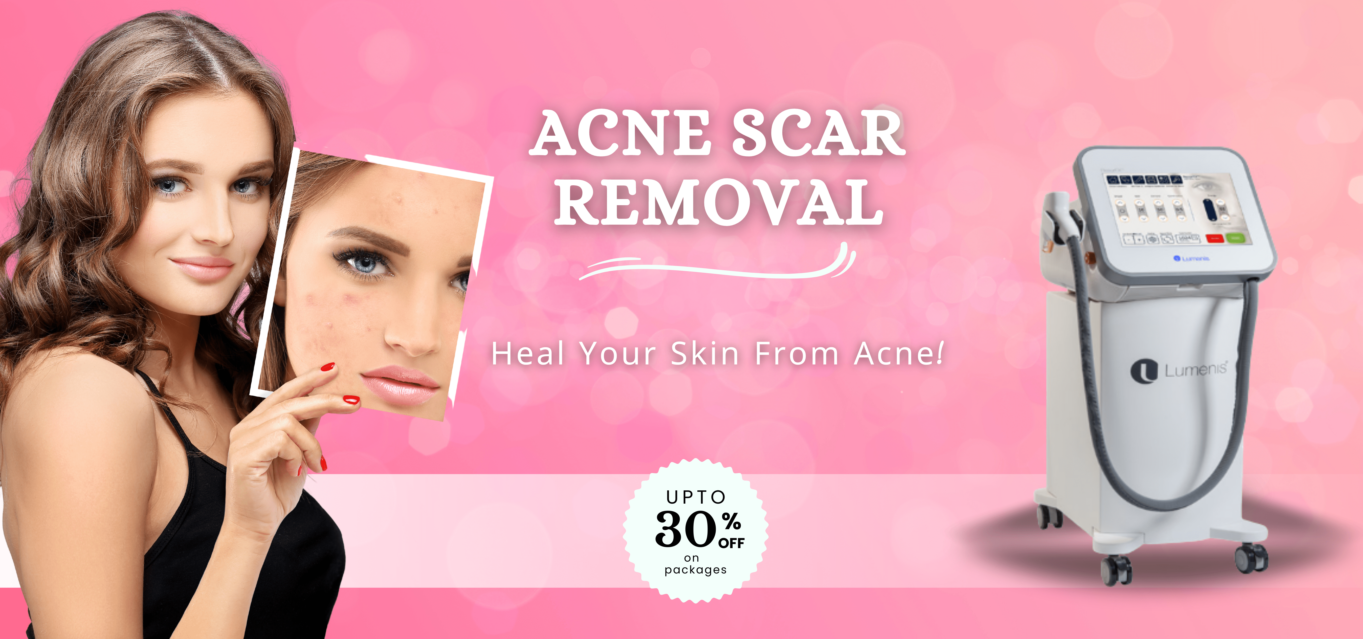 Acne Scar Removal