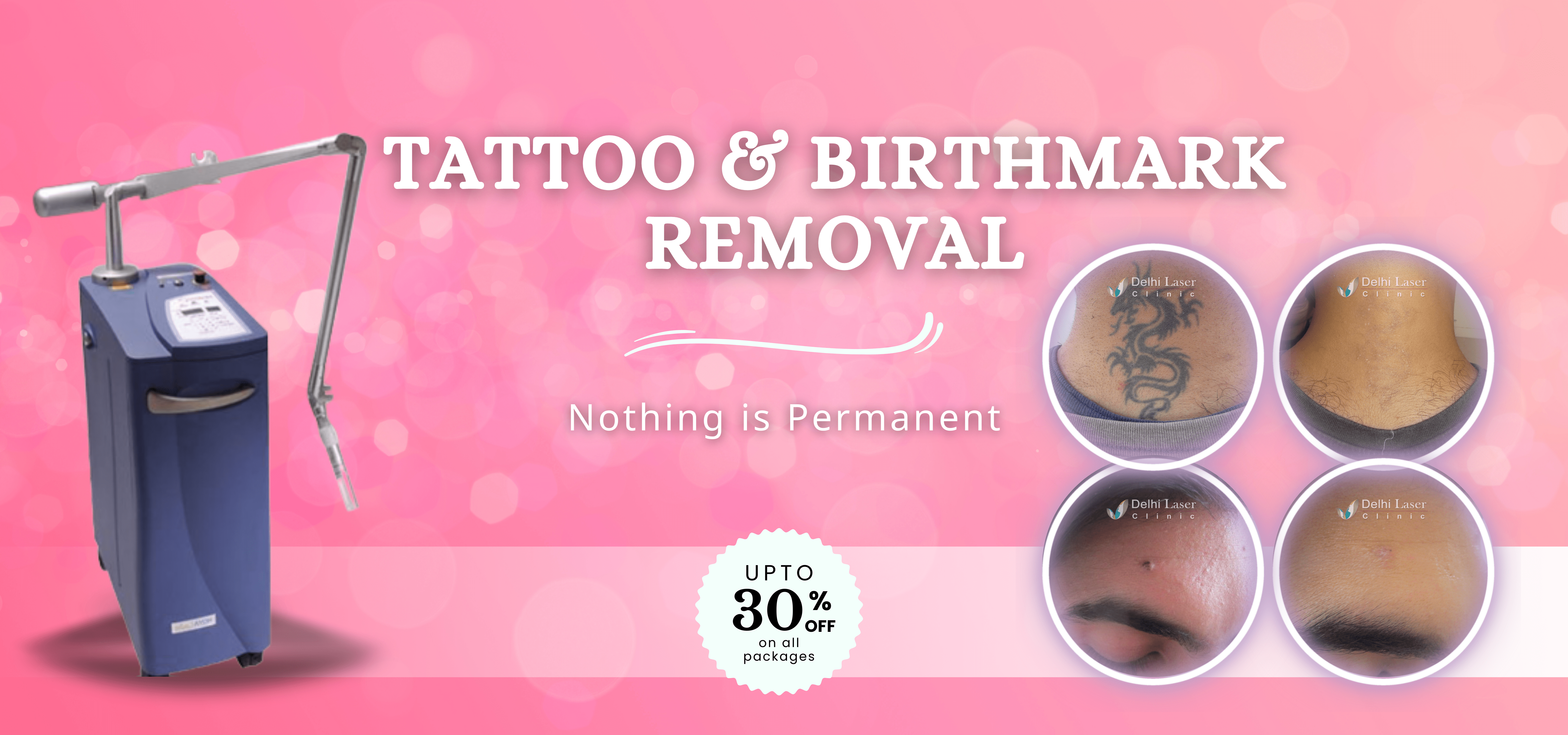 Tattoo Removal